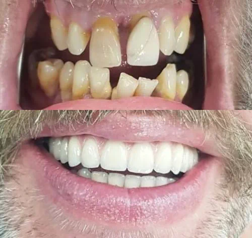 Reabilitação Total